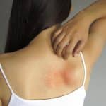 Dermatite atopica: identificati i mediatori biochimici che scatenano il prurito %dermatite atopica: identificati i mediatori biochimici che scatenano il pruritocount(title)% Dermatite atopica: identificati i mediatori biochimici che scatenano il prurito