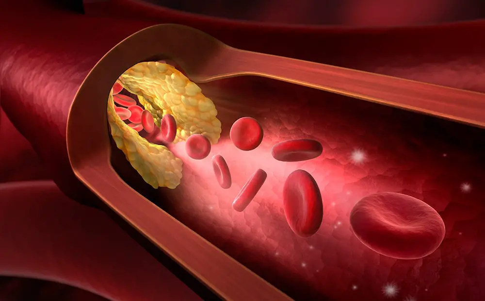 Malattie cardiache, ateriosclerosi