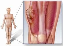 Sarcoma