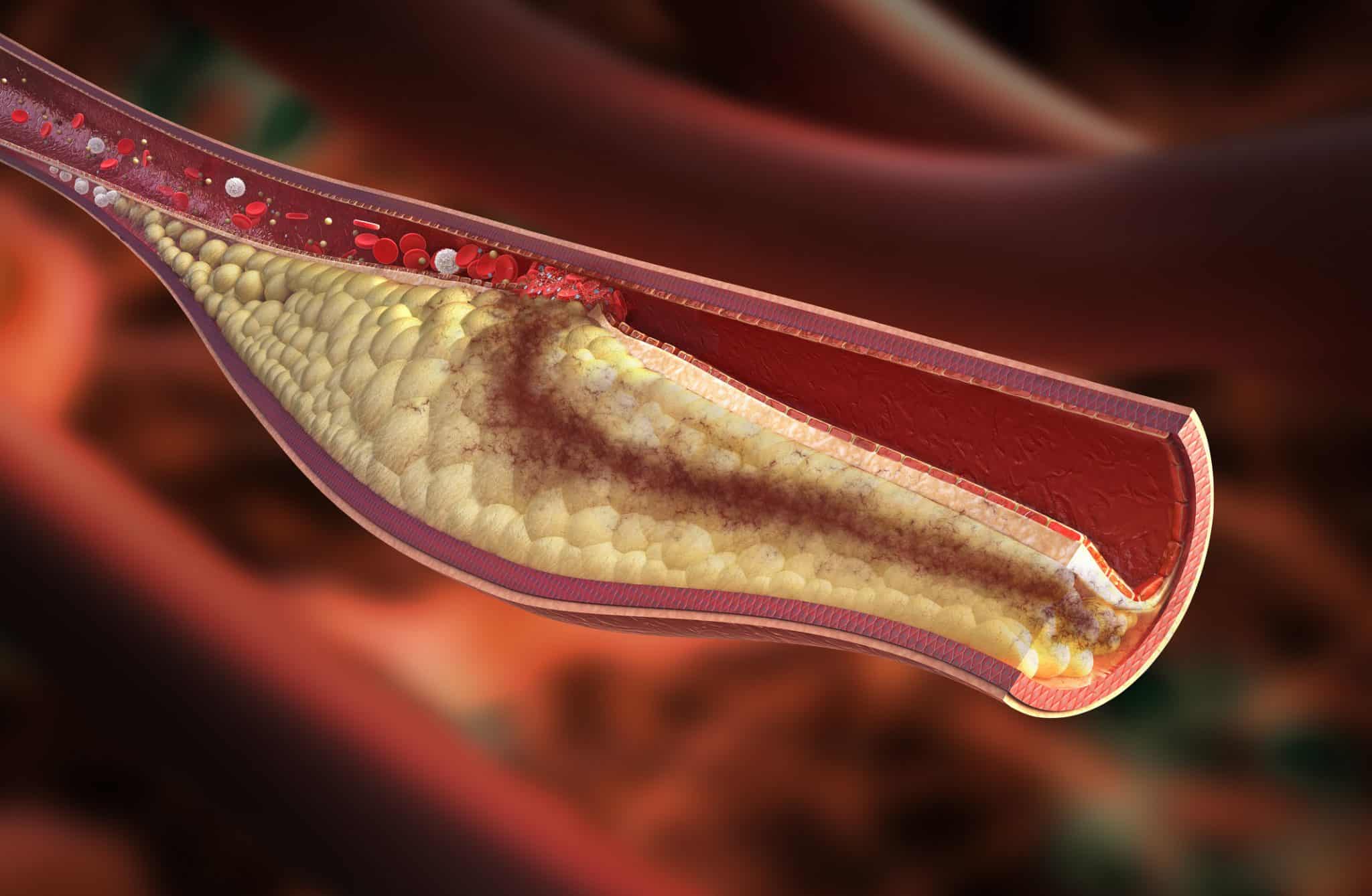 Malattie cardiache