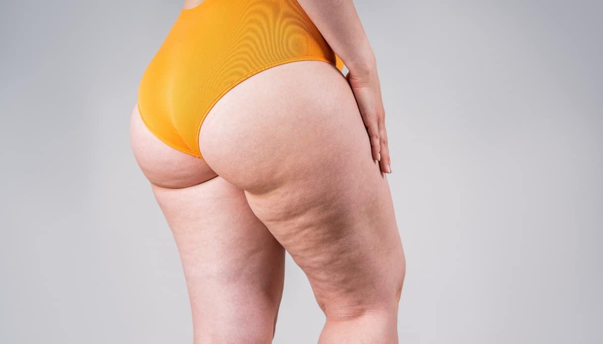 Lipedema, ictus