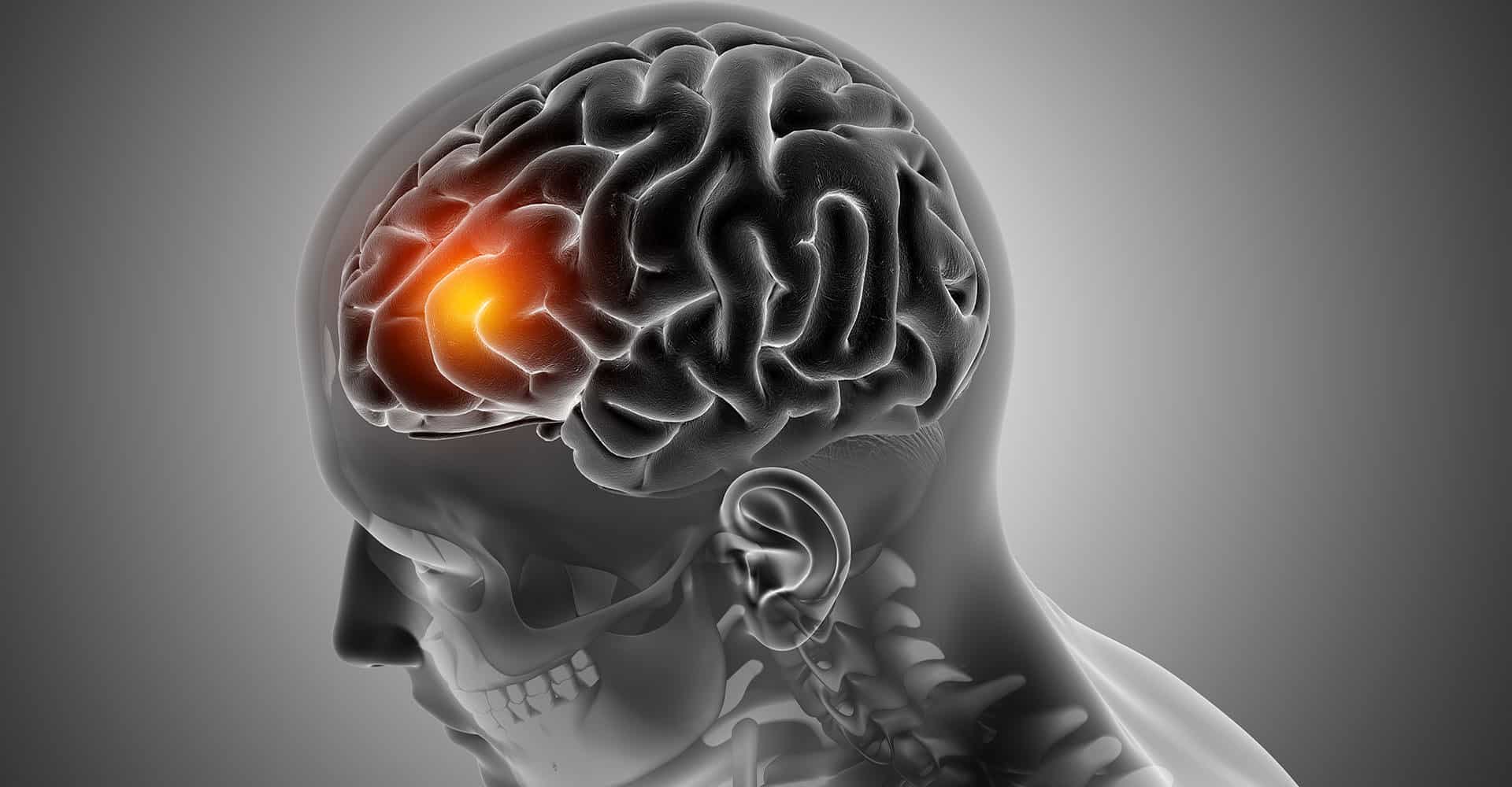 Ischemic stroke