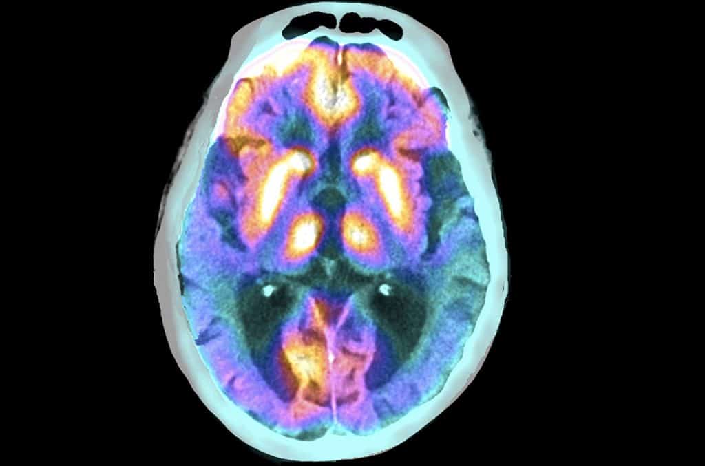 Alzheimer's disease, lecanemab