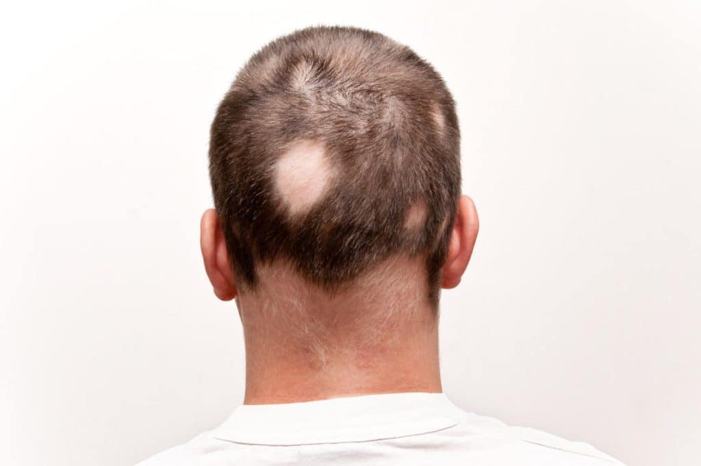 Alopecia areata 