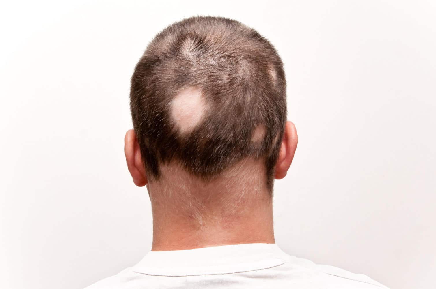 Alopecia areata