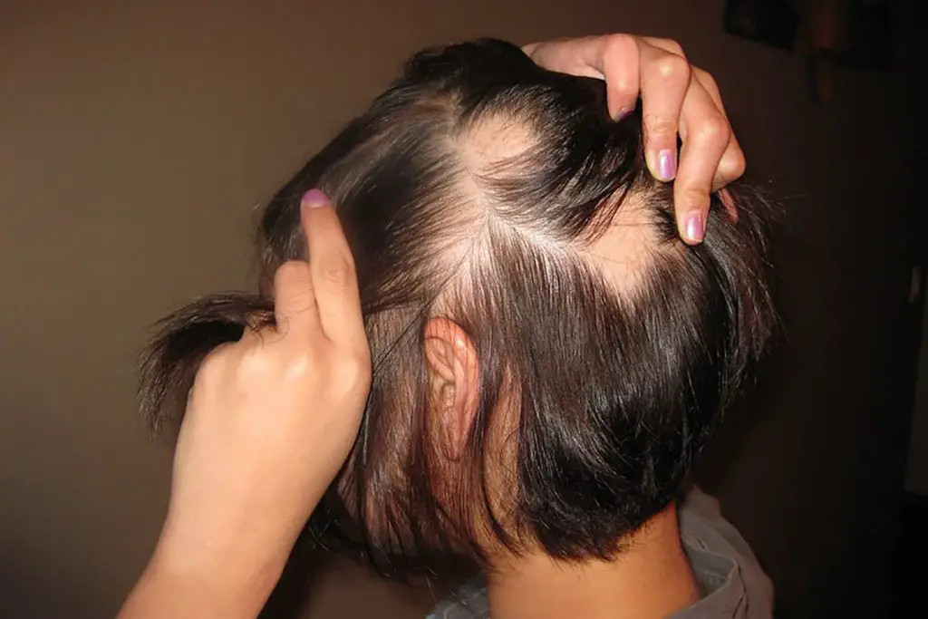 Alopecia areata 