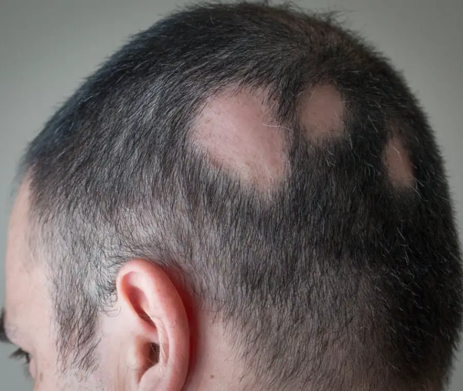 Alopecia areata 