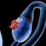 Cancro ovarico: la ricerca e l'ingegneria uniscono le forze per offrire concrete prospettive di guarigione