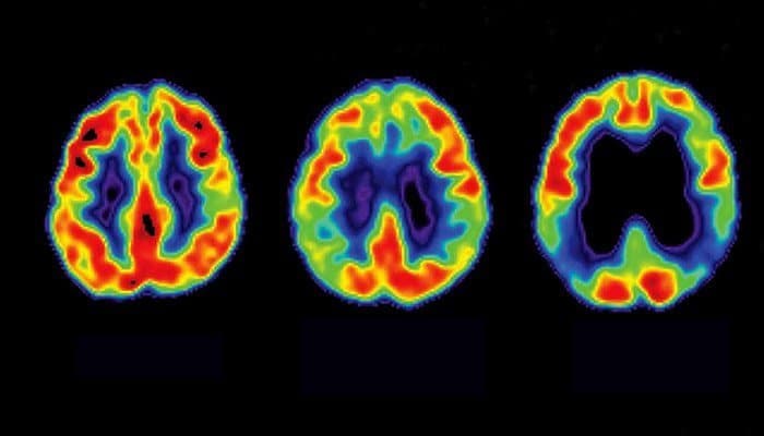 Malattia di alzheimer, lecanemab