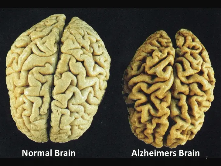 Malattia di Alzheimer 