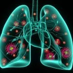 Cancro al polmone: identificata la causa dei fallimenti terapeutici