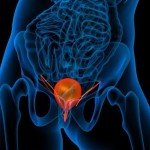 Cancro alla prostata 