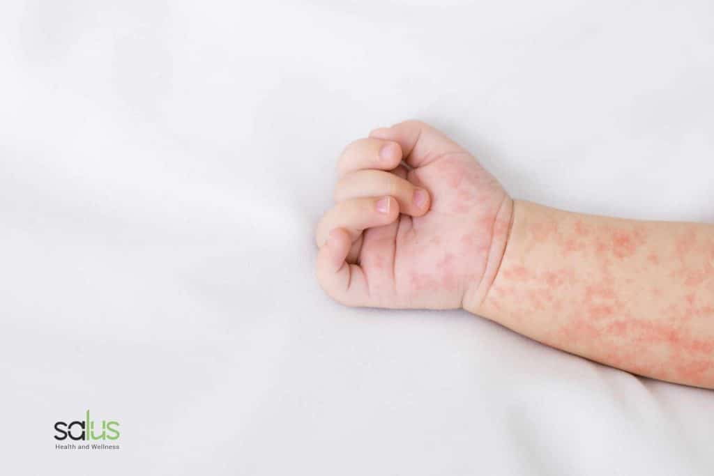Dermatite atopica: top 5 delle terapie più innovative %dermatite atopica: top 5 delle terapie più innovativecount(title)% Dermatite atopica: top 5 delle terapie più innovative