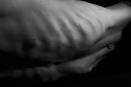 Anoressia nervosa