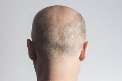 Calvizie e alopecia: guida si sintomi da non sottovalutare, le terapie più innovative ed efficaci, le cliniche più all'avanguardia