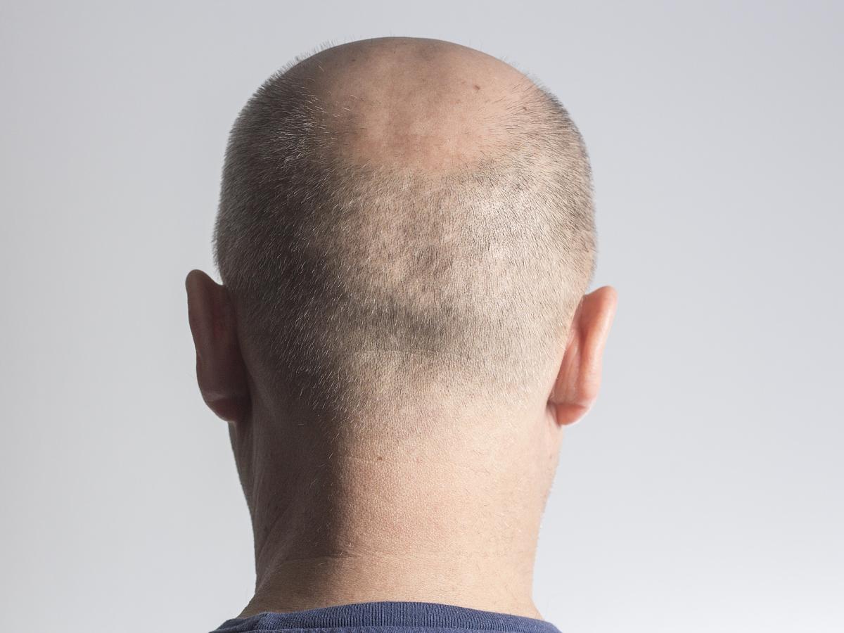 Minoxidil, un farmaco, 3 vittorie: una terapia efficace per l'ipertensione, l'alopecia e la calvizie