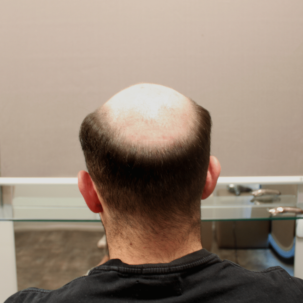 Alopecia e calvizie: scoperta pp405, la molecola che riattiva la crescita dei capelli