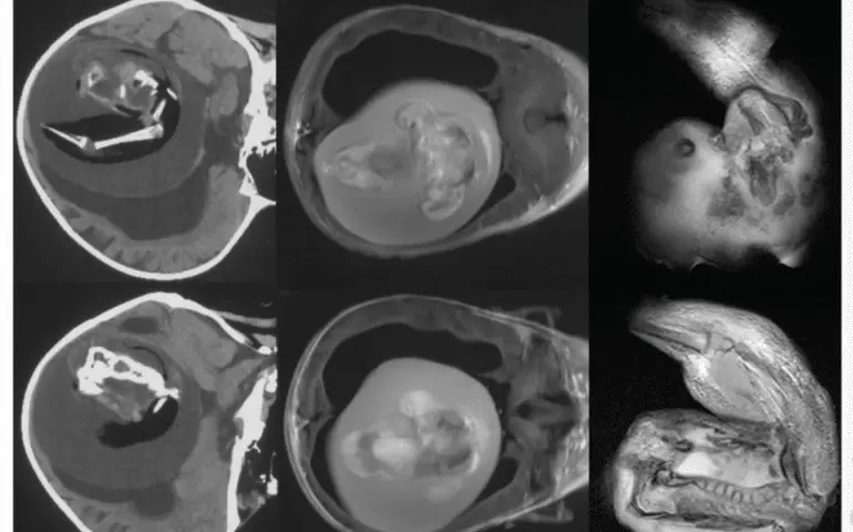 Itzamara: la neonata venuta al mondo incinta