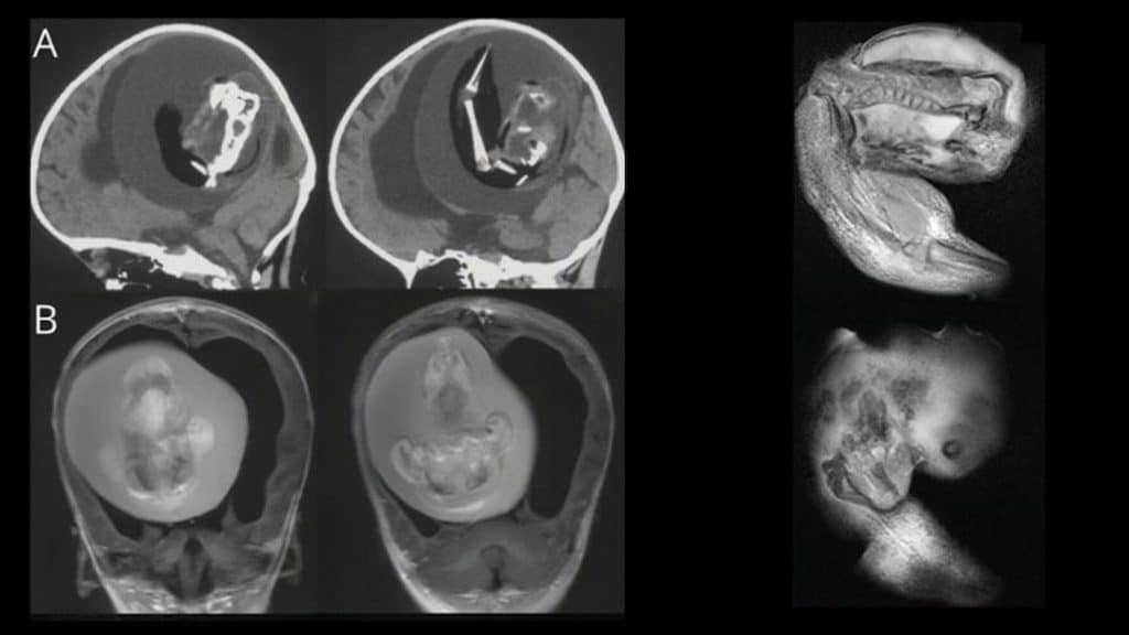 Itzamara: la neonata venuta al mondo incinta