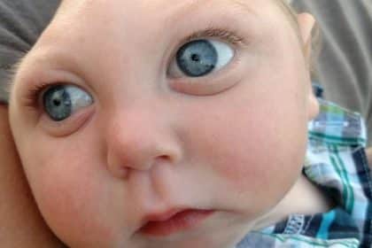 Jaxon buell, il "miracle boy" è vissuto senza l'80% del cervello