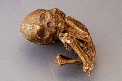 Bambino di pietra: il mistero del feto calcificato nascosto nel ventre materno - foto