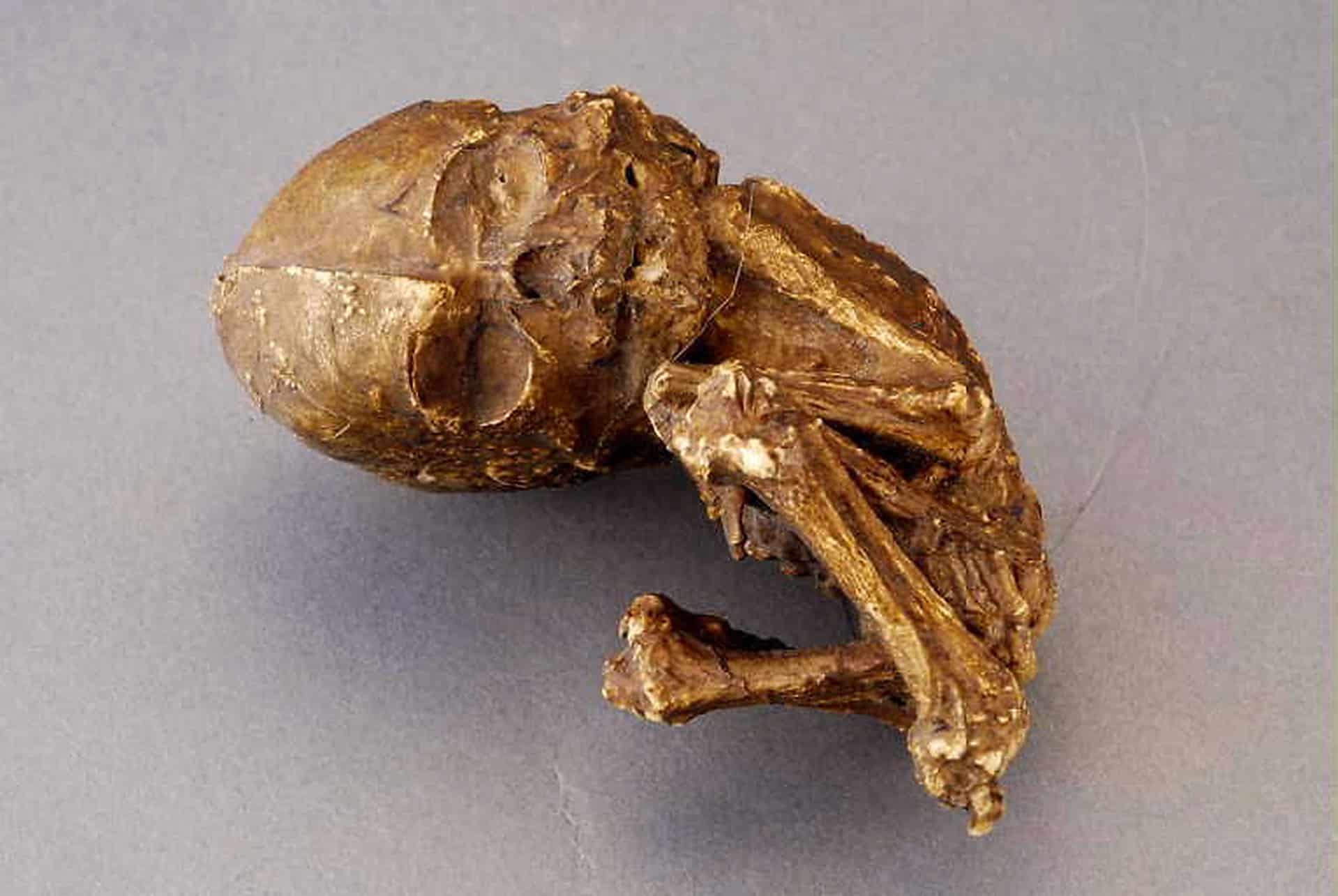 Bambino di pietra: il mistero del feto calcificato nascosto nel ventre materno - foto