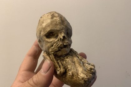 Bambino di pietra: il mistero del feto calcificato nascosto nel ventre materno - foto