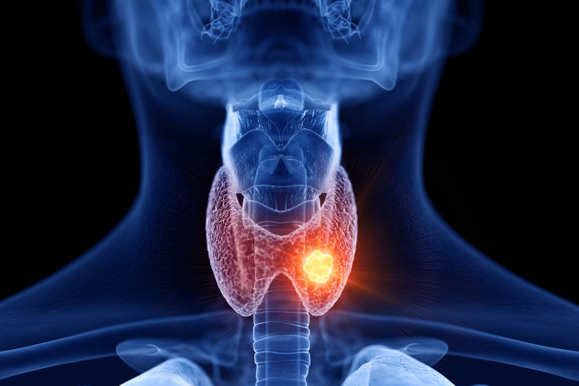 Emcitate approvato dalla fda per la carenza mct8: cosa cambia %emcitate approvato dalla fda per la carenza mct8: cosa cambiacount(title)% Tiroide e ormoni tiroidei