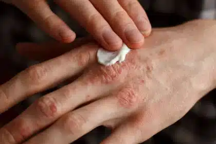 Pepitem: nuovo studio individua una moltecola naturale che agisce significativamente sulle lesioni da psoriasi