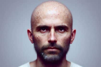 Proteina mcl-1: nuovo studio ha dimostrato che supporta la ricrescita dei capelli nell'alopecia e nelle calvizie