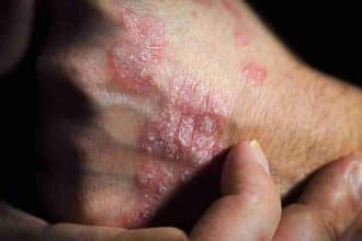 Psoriasi: guida alle terapie più efficaci, alle ricerche più promettenti e alle cliniche italiane più all'avanguardia