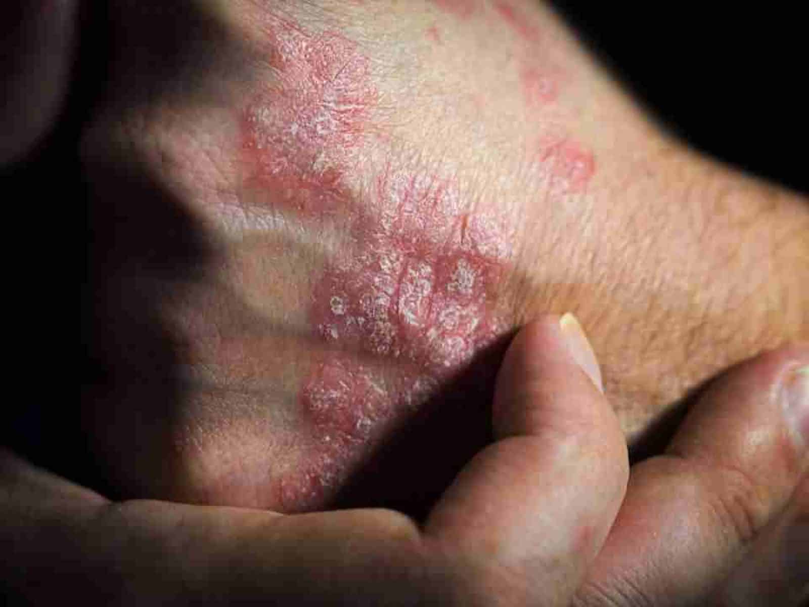 Risankizumab: pelle libera più a lungo grazie alla nuova strategia clinica
