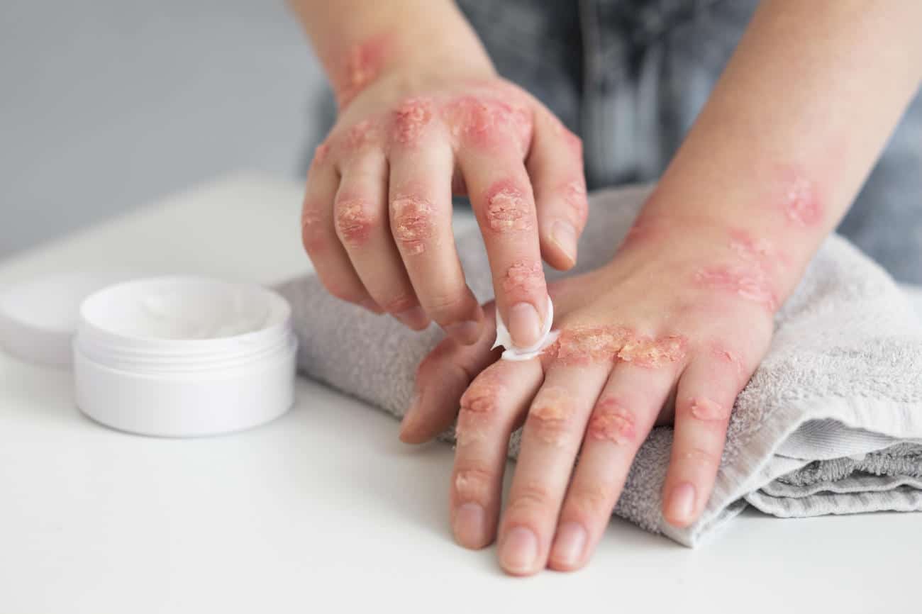 Psoriasi: la dieta mediterranea, non la perdita di peso, è la chiave per il 75% di pelle più sana