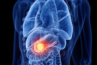 Cancro al pancreas: guida ai sintomi più subdoli, le terapie più efficaci, le cliniche più all'avanguardia