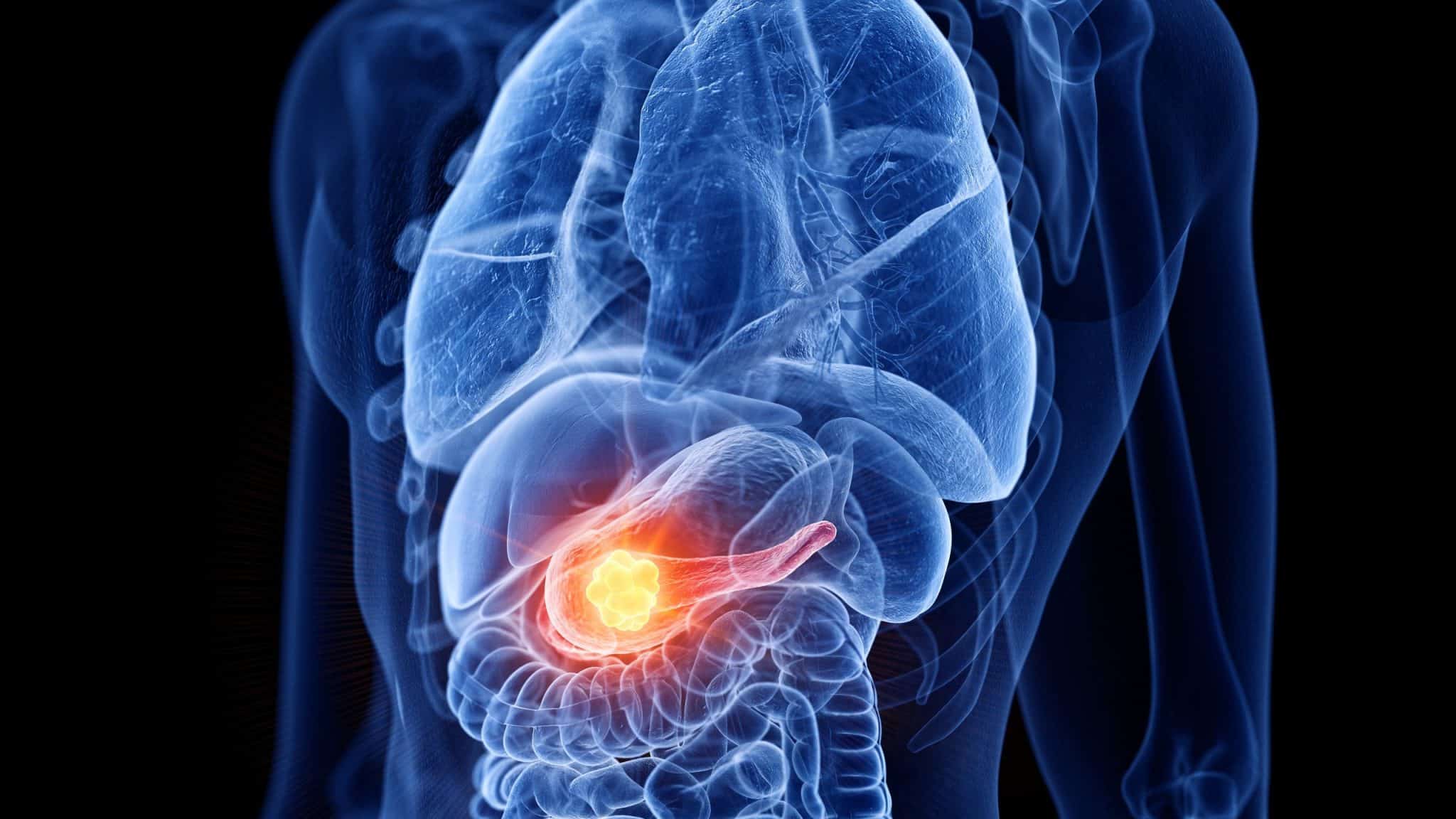 Cancro al pancreas: guida ai sintomi più subdoli, le terapie più efficaci, le cliniche più all'avanguardia