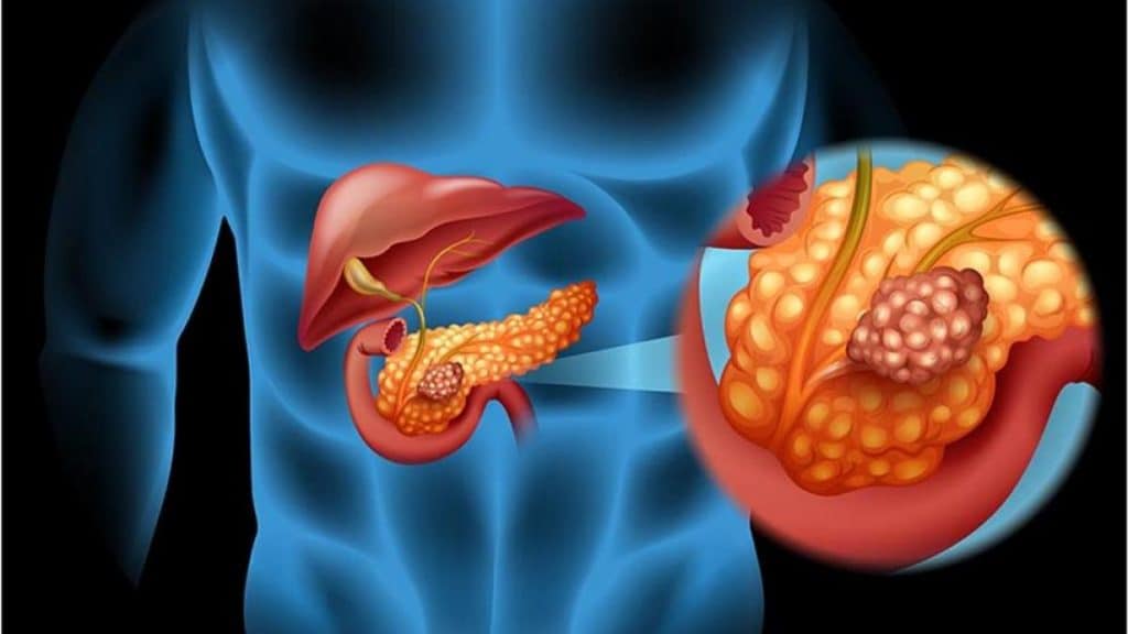 Cancro al pancreas: guida ai sintomi più subdoli, le terapie più efficaci, le cliniche più all'avanguardia %cancro al pancreas: guida ai sintomi più subdoli, le terapie più efficaci, le cliniche più all'avanguardiacount(title)% Cancro al pancreas: guida ai sintomi più subdoli, le terapie più efficaci, le cliniche più all'avanguardia