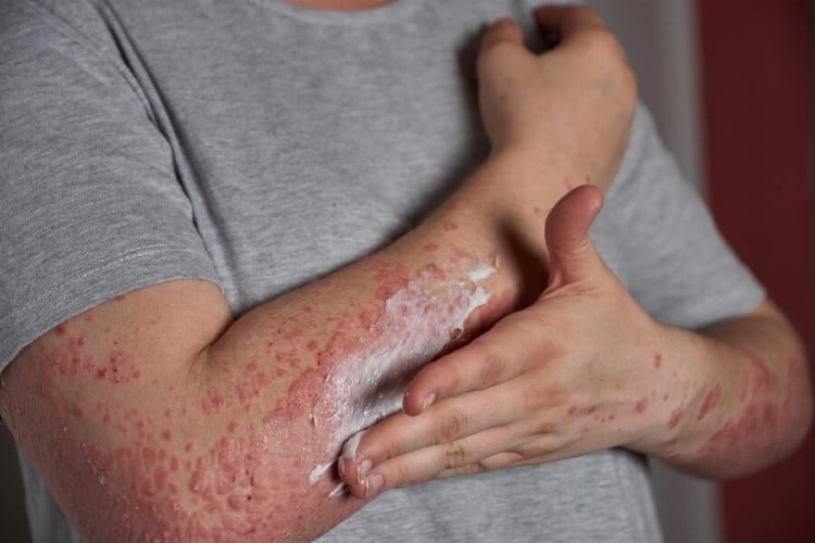 Lupus e trombosi: identificati gli anticorpi predittivi di coaguli %lupus e trombosi: identificati gli anticorpi predittivi di coagulicount(title)% Lupus e trombosi: identificati gli anticorpi predittivi di coaguli