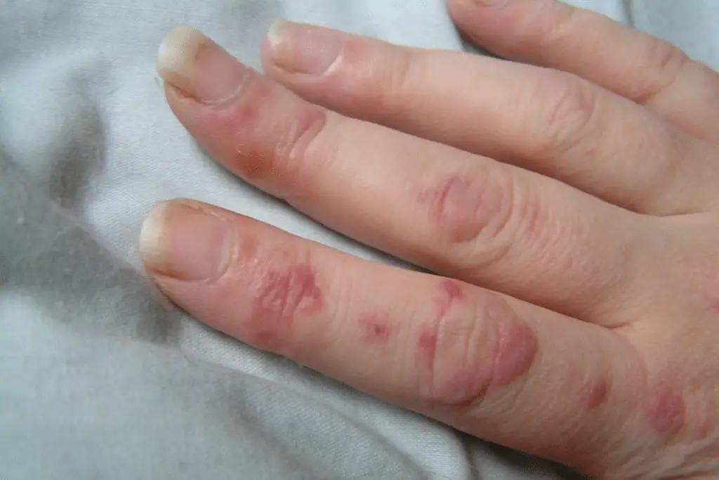 Lupus e trombosi: identificati gli anticorpi predittivi di coaguli %lupus e trombosi: identificati gli anticorpi predittivi di coagulicount(title)% Lupus e trombosi: identificati gli anticorpi predittivi di coaguli