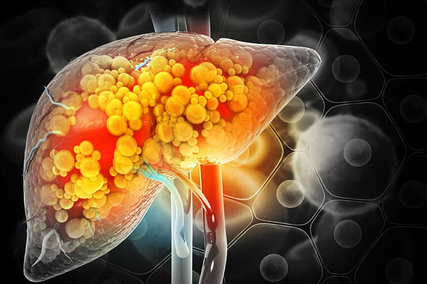 Fibrosi epatica: olr1 nei macrofagi è un nuovo bersaglio? %fibrosi epatica: olr1 nei macrofagi è un nuovo bersaglio? Count(title)% Fegato e fibrosi epatica