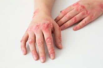 Lupus e trombosi: identificati gli anticorpi predittivi di coaguli