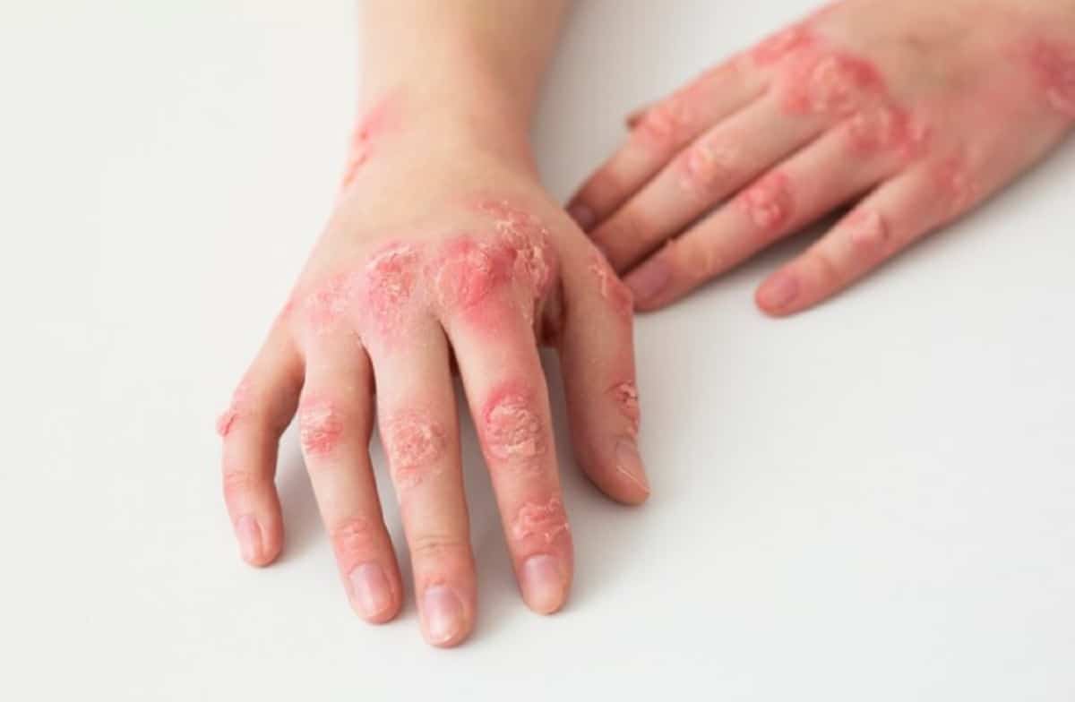 Lupus e trombosi: identificati gli anticorpi predittivi di coaguli