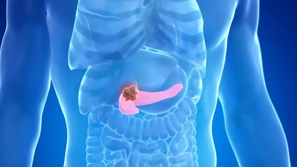 Cancro al pancreas: guida ai sintomi più subdoli, le terapie più efficaci, le cliniche più all'avanguardia %cancro al pancreas: guida ai sintomi più subdoli, le terapie più efficaci, le cliniche più all'avanguardiacount(title)% Cancro al pancreas: guida ai sintomi più subdoli, le terapie più efficaci, le cliniche più all'avanguardia