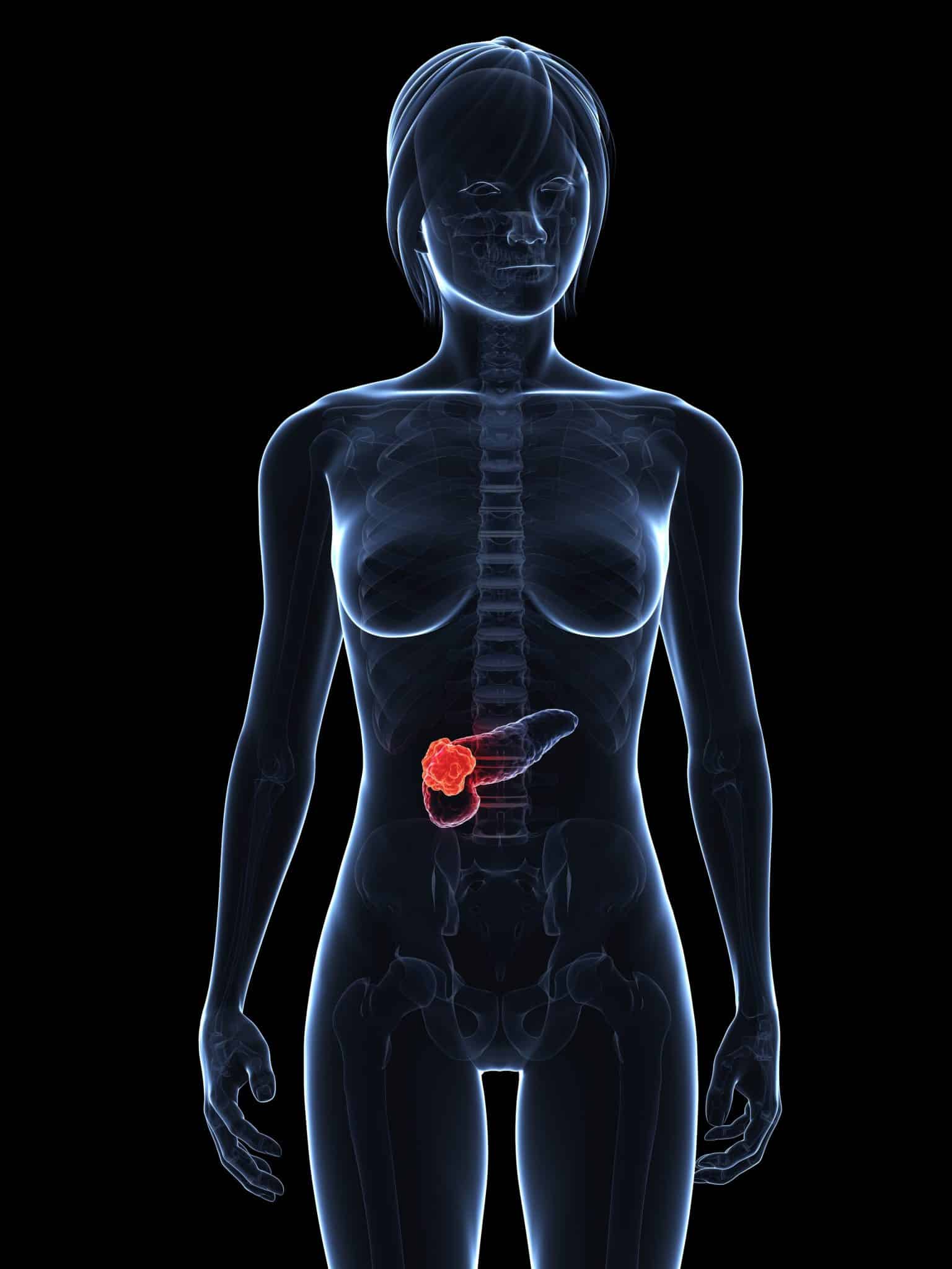 Carcinoma pancreatico metastatico: traguardi straordinari e nuove prospettive di guarigione