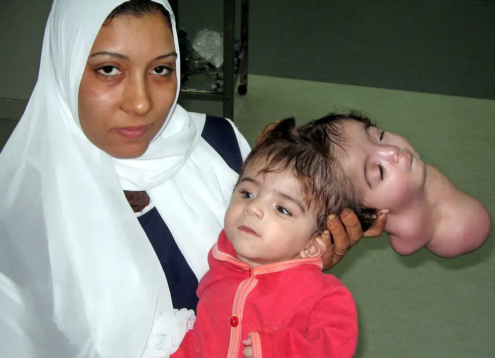 Manar maged: la tragica storia della bambina nata con 2 teste -foto %manar maged: la tragica storia della bambina nata con 2 teste -fotocount(title)% Manar maged: la tragica storia della bambina nata con 2 teste -foto