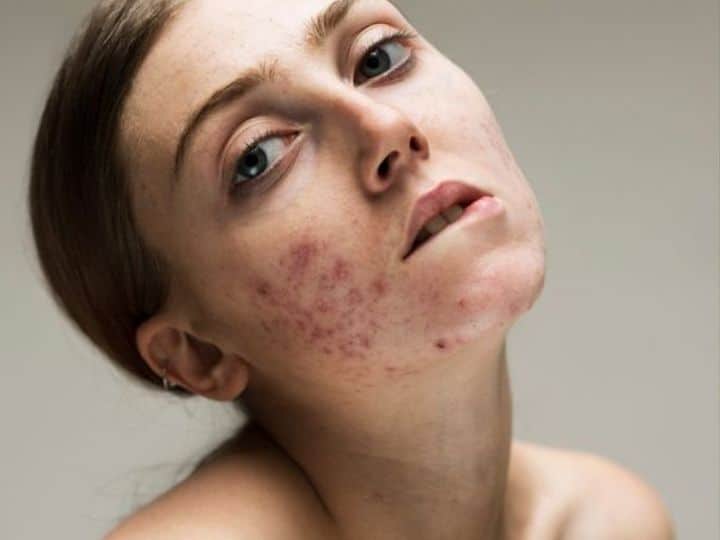 Idrosadenite suppurativa: la vlckd è la nuova alleata per un miglioramento concreto %idrosadenite suppurativa: la vlckd è la nuova alleata per un miglioramento concretocount(title)% Idrosadenite suppurativa: la vlckd è la nuova alleata per un miglioramento concreto