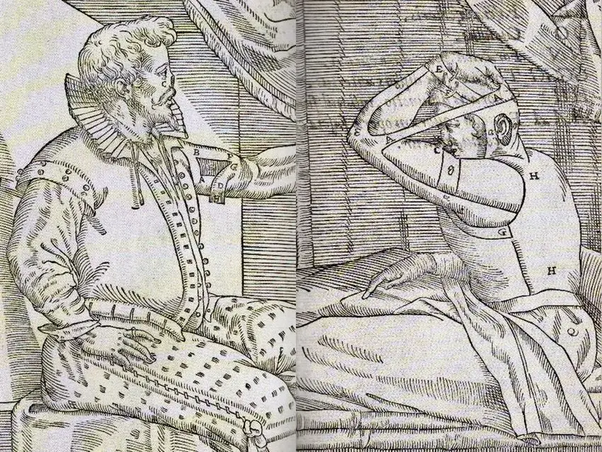 Gaspare tagliacozzi: quando la rinoplastica nel '500 richiedeva settimane di torture fisiche -immagini %gaspare tagliacozzi: quando la rinoplastica nel '500 richiedeva settimane di torture fisiche -immaginicount(title)% Gaspare tagliacozzi: quando la rinoplastica nel '500 richiedeva settimane di torture fisiche -immagini