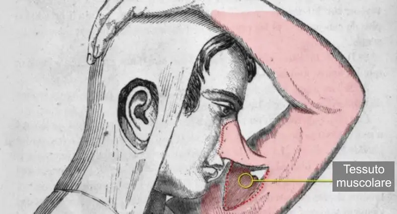 Gaspare tagliacozzi: quando la rinoplastica nel '500 richiedeva settimane di torture fisiche -immagini %gaspare tagliacozzi: quando la rinoplastica nel '500 richiedeva settimane di torture fisiche -immaginicount(title)% Gaspare tagliacozzi: quando la rinoplastica nel '500 richiedeva settimane di torture fisiche -immagini