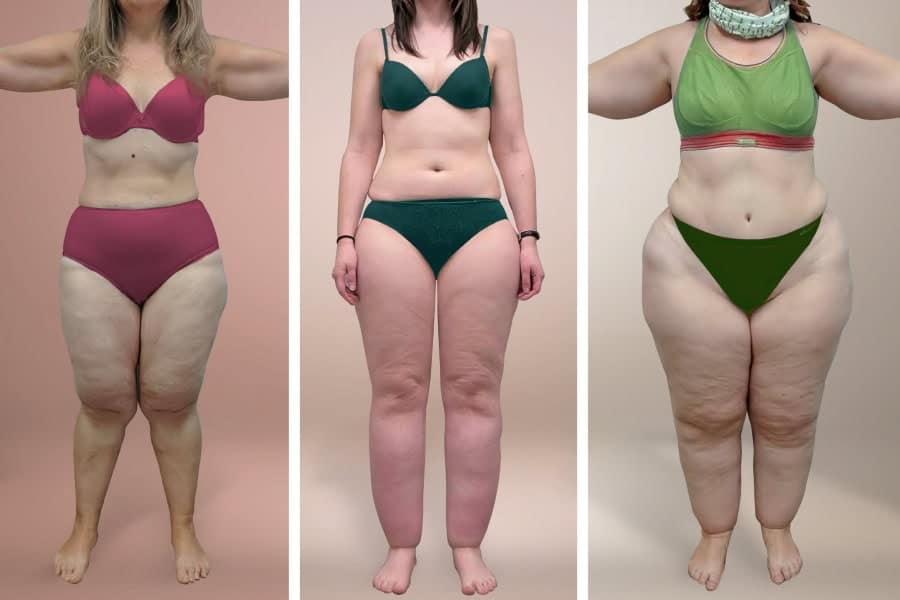 Linfedema e lipedema: top 5 delle terapie più efficaci e innovative %linfedema e lipedema: top 5 delle terapie più efficaci e innovativecount(title)% Linfedema e lipedema: top 5 delle terapie più efficaci e innovative