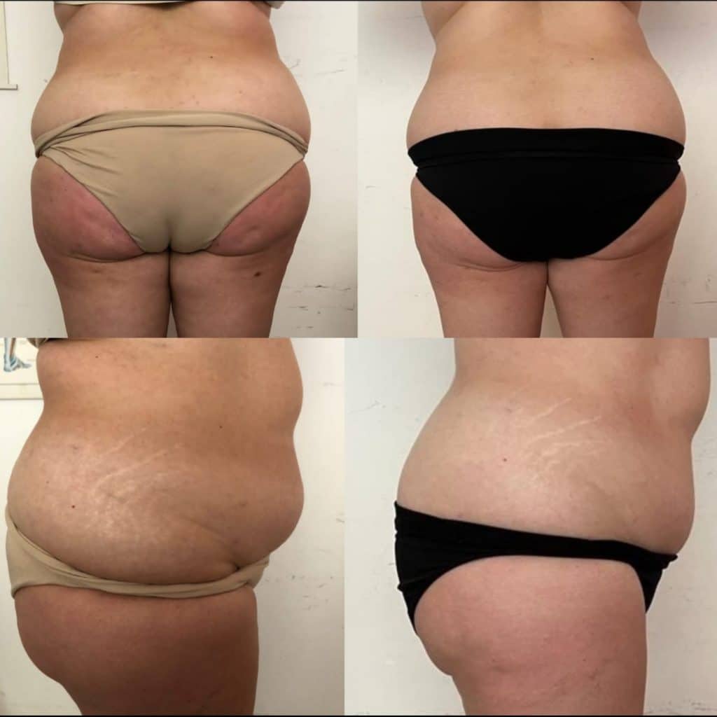 Linfedema e lipedema: top 5 delle terapie più efficaci e innovative %linfedema e lipedema: top 5 delle terapie più efficaci e innovativecount(title)% Linfedema e lipedema: top 5 delle terapie più efficaci e innovative