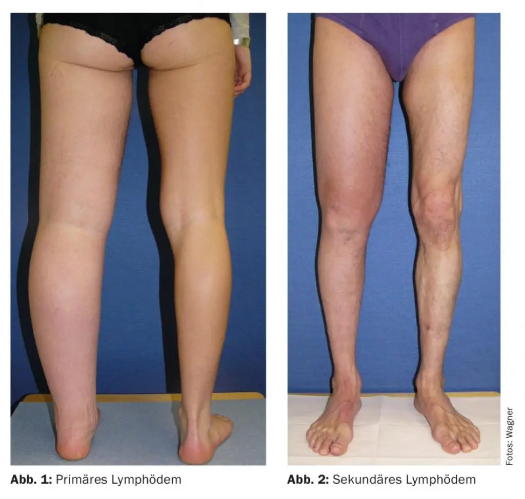 Linfedema e lipedema: top 5 delle terapie più efficaci e innovative %linfedema e lipedema: top 5 delle terapie più efficaci e innovativecount(title)% Linfedema e lipedema: top 5 delle terapie più efficaci e innovative